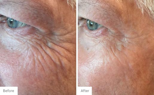 3 - Before and After Real Results photo of a man's eye area.