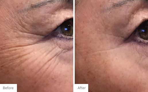 1 - Before and After Real Results photo of a woman's eye area.